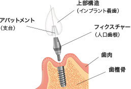 インプラントの構造
