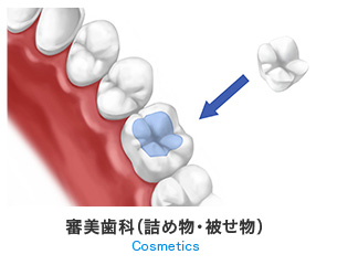 審美歯科(詰め物・被せ物)